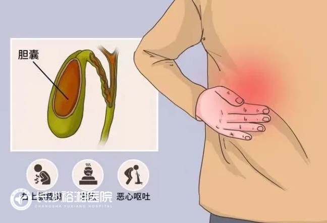 膽囊結(jié)石.png